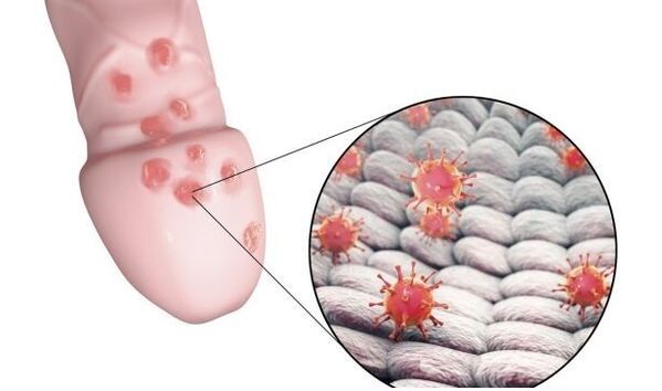 Alerxia ao xel para aumentar o pene