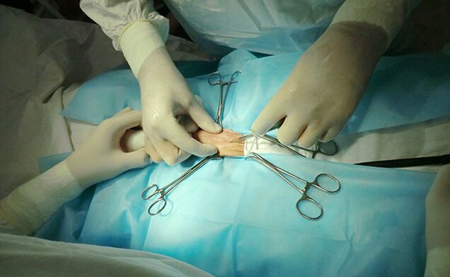 A cirurxía do órgano reprodutor pode axudar a aumentar o seu tamaño