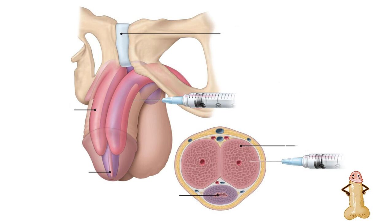 Inxeccións de ácido hialurónico para a ampliación do pene